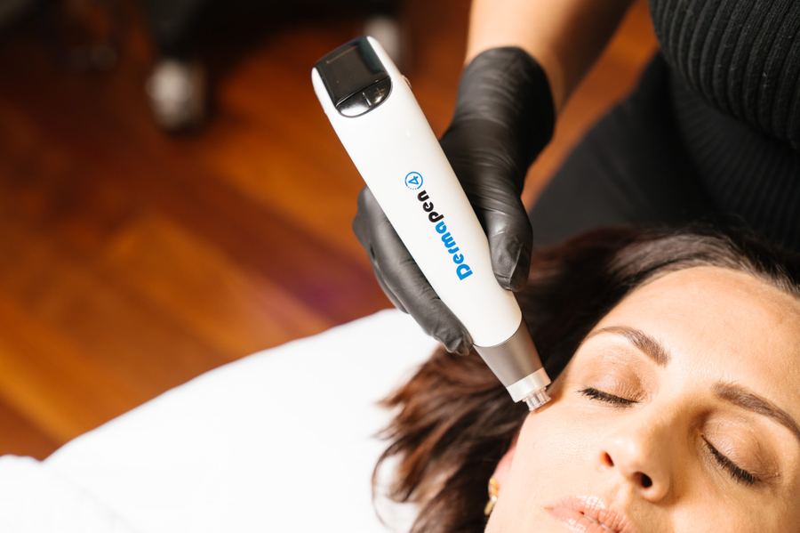 Exosome Microneedling