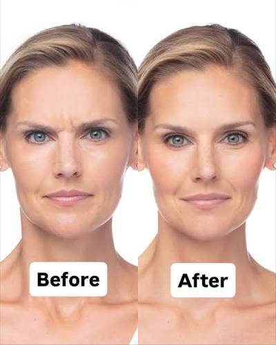 Dysport comparison supplied by the clinic, before on the left and after on the right